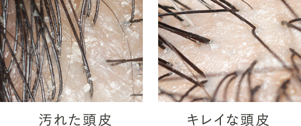 汚れた頭皮 キレイな頭皮